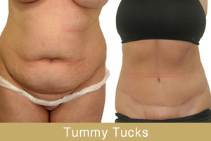 extended tummy tucks before and after