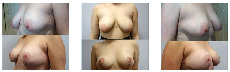 Before and after photographs of breast reduction results surgery performed by Aset Hospital Mr Gerard Lambe consultant plastic surgeon