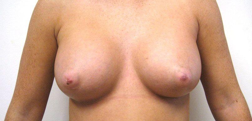 photo showingfter breast enlargement procedure showing a fuller larger breast