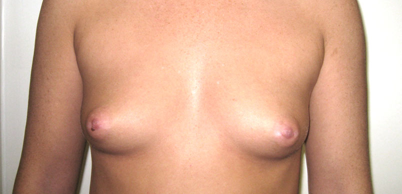 Before breast enlargement procedure showing small breast size 