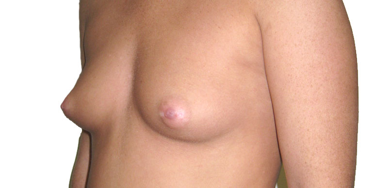 Before breast enlarement surgery