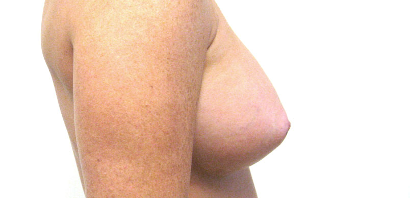 After breast asymmetry procedure to make breast even
