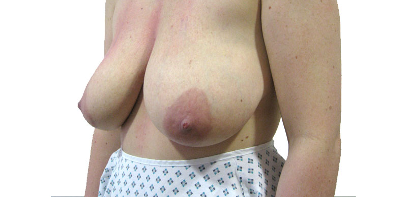 Before mammplasty surgery photo 