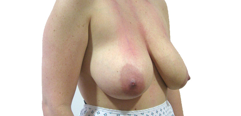 Before mammaplasty breast reduction procedure