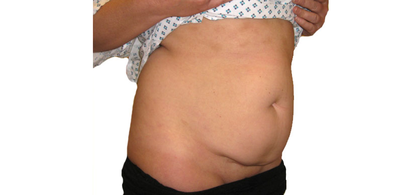 Before tummy tuck Gallery