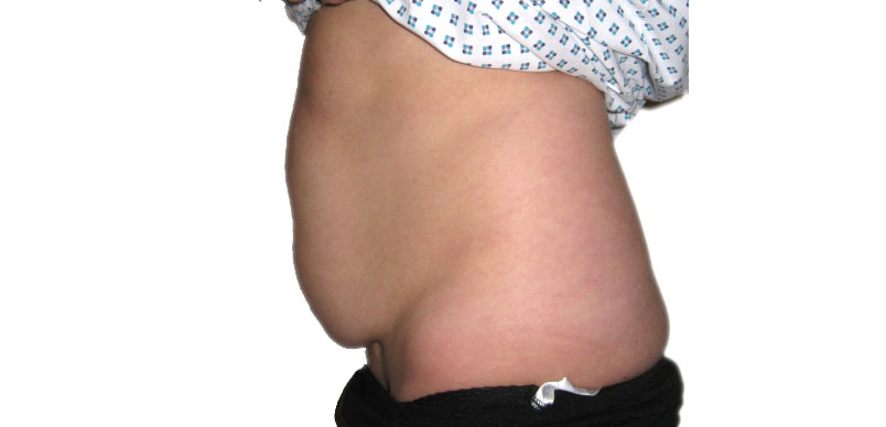 photo before correction cosmetic surgery for loose stomach skin and excess fat at Aset hospital