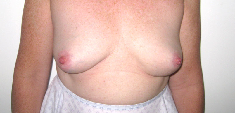 breast surgery to correct wide cleavage and lateral position of nippleBefore Gallery