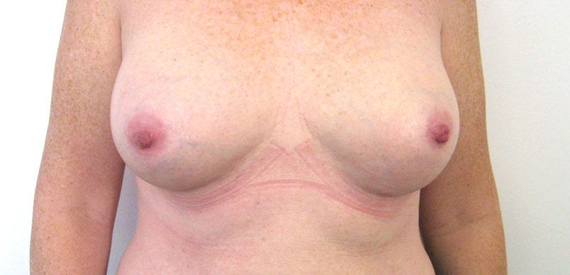After surgery implants used to correct wide cleavage and change of lateral position of nippleGallery