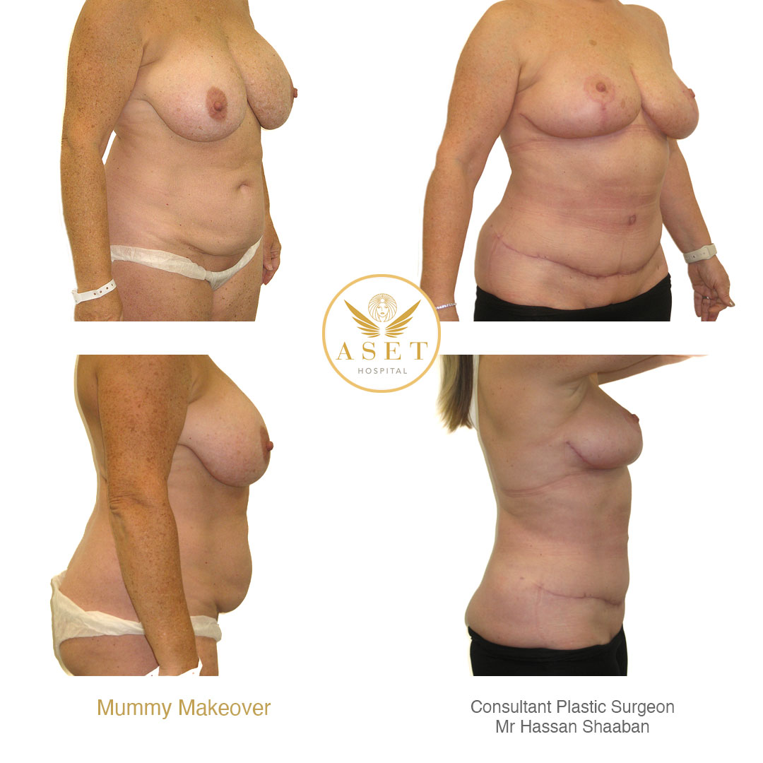 The mummy makeover abdominoplasty and breast reduction and uplift before and after photos surgeon Mr Hassan Shaaban