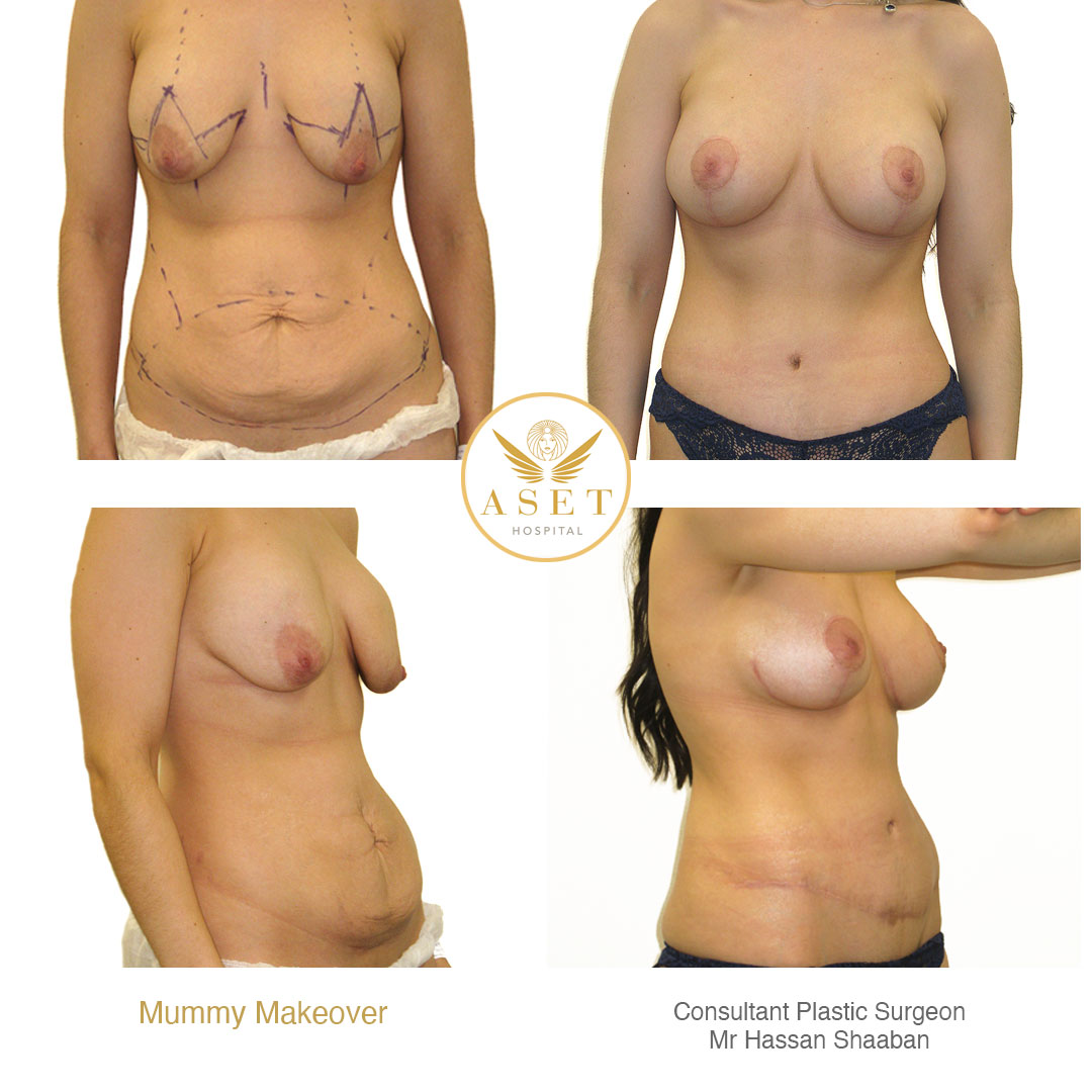 photographs showing a double bubble breast deformity correction before and after 