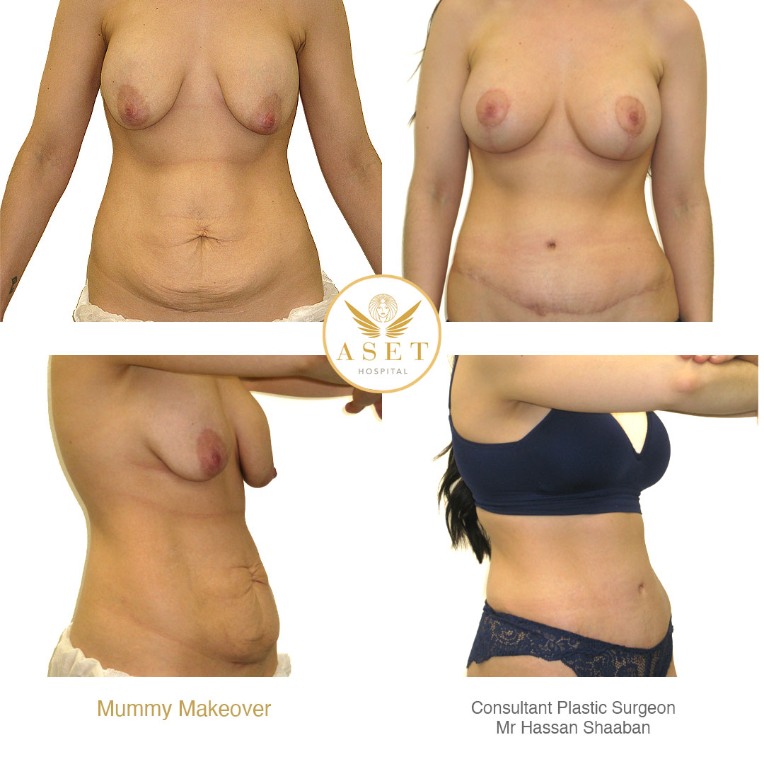 photographs of before and after mummy makeover, includes a abdominoplasty and breast procedure