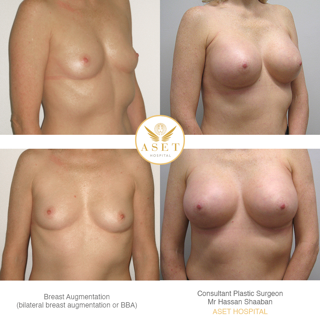 breast augumentations before and after photograph