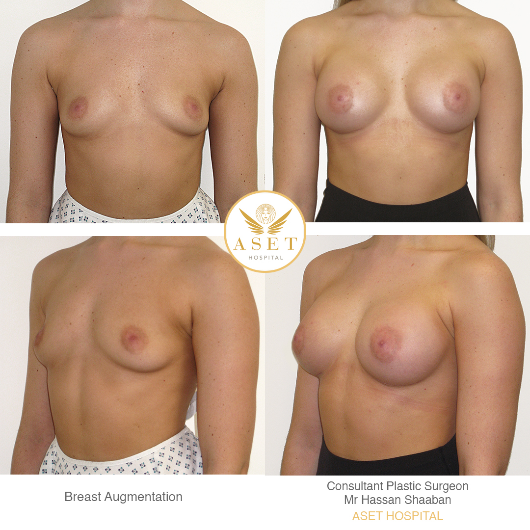 photograph showing before and after a breast augmentation breast enlargement procedure