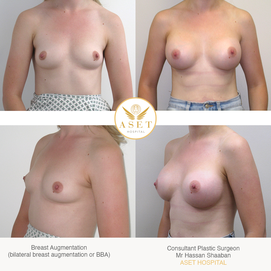 BBA bilateral breast augmentation before and after photos surgeon Mr Hassan Shaaban