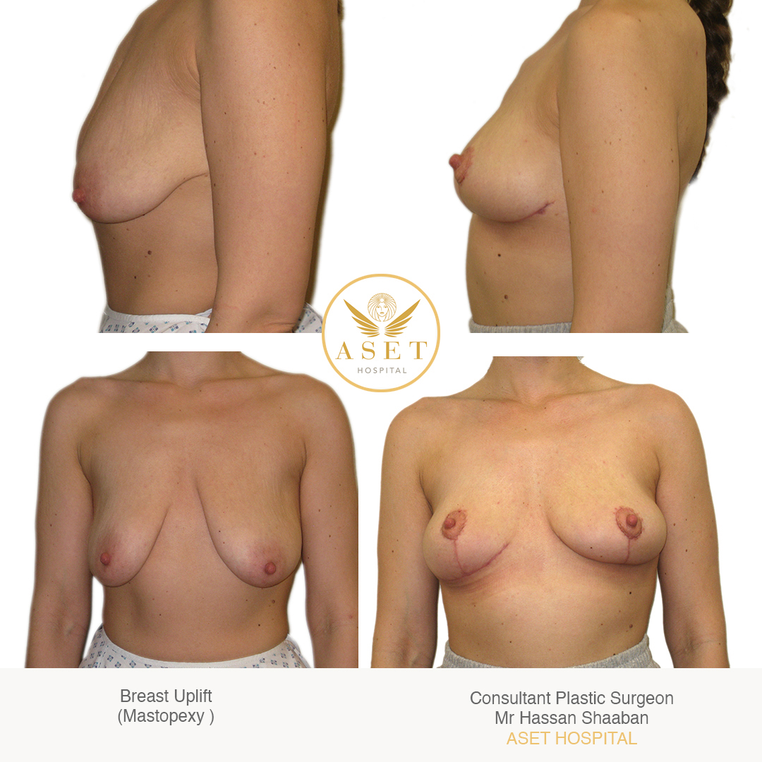 photograph showing sagging breast and the effects of a breast uplift 