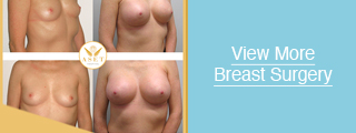 View photographs of before and after cosmetic breast surgery at Aset Hospital