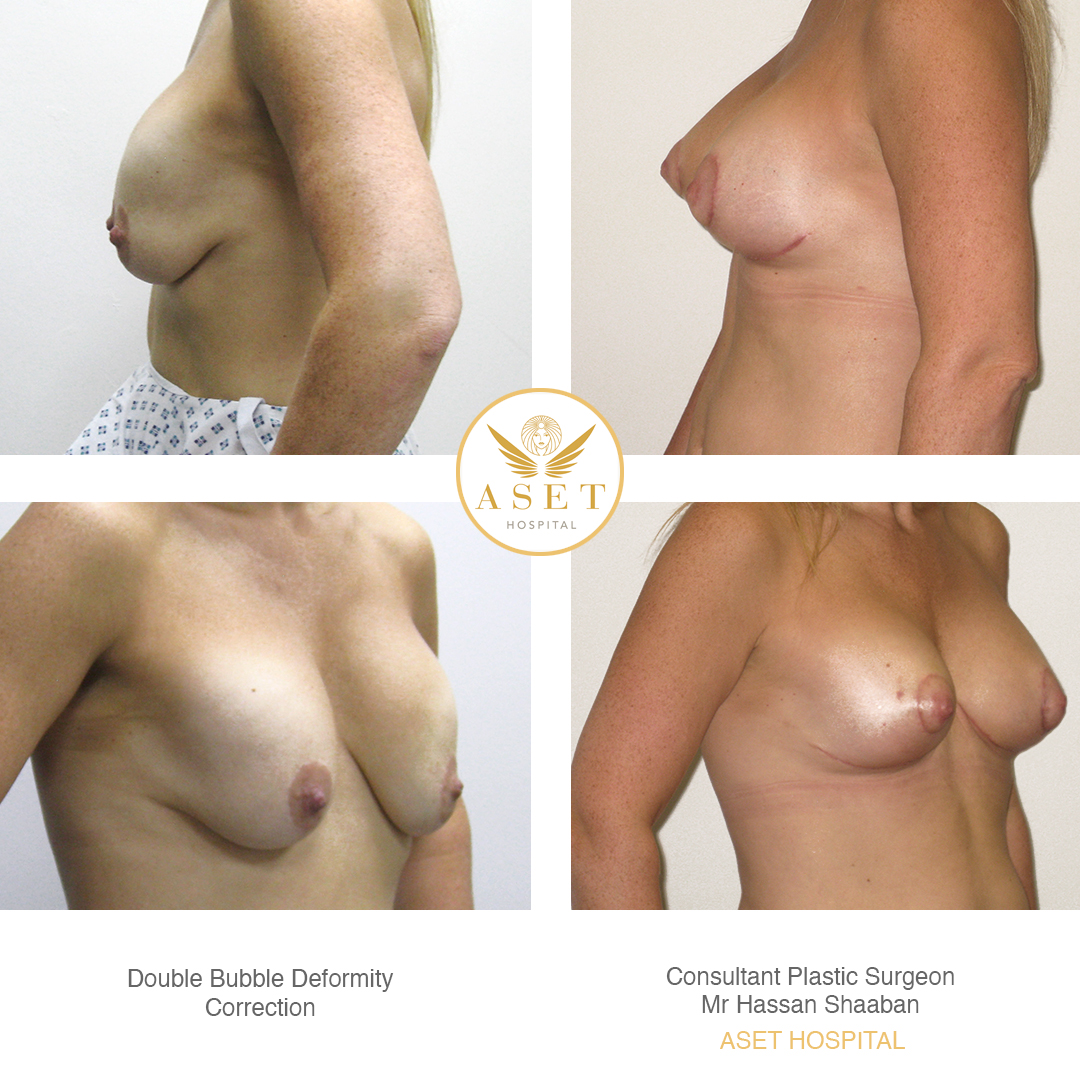 breast correction surgery before and after phtographs of a double bubble deformity