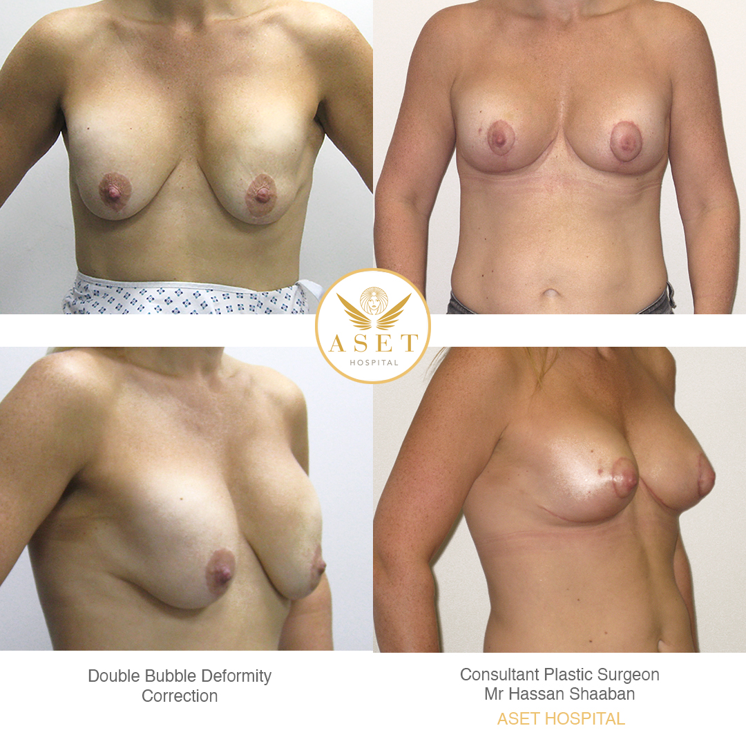 photographs showing a double bubble breast deformity correction before and after 