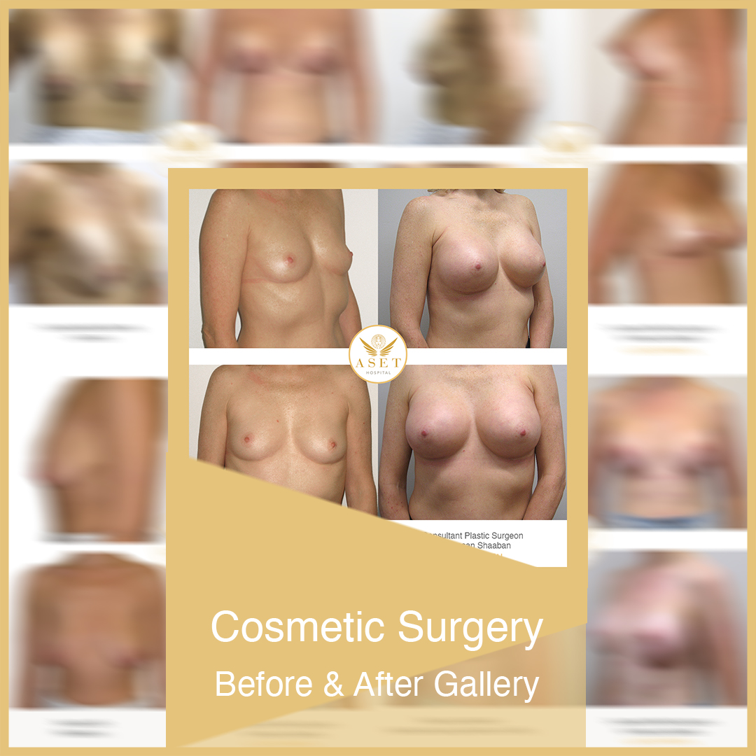 cosmetic plastic breast surgery before and after photographs