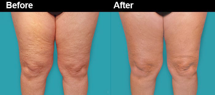 cellulite reduction after one treatment using cellulaze at Aset 