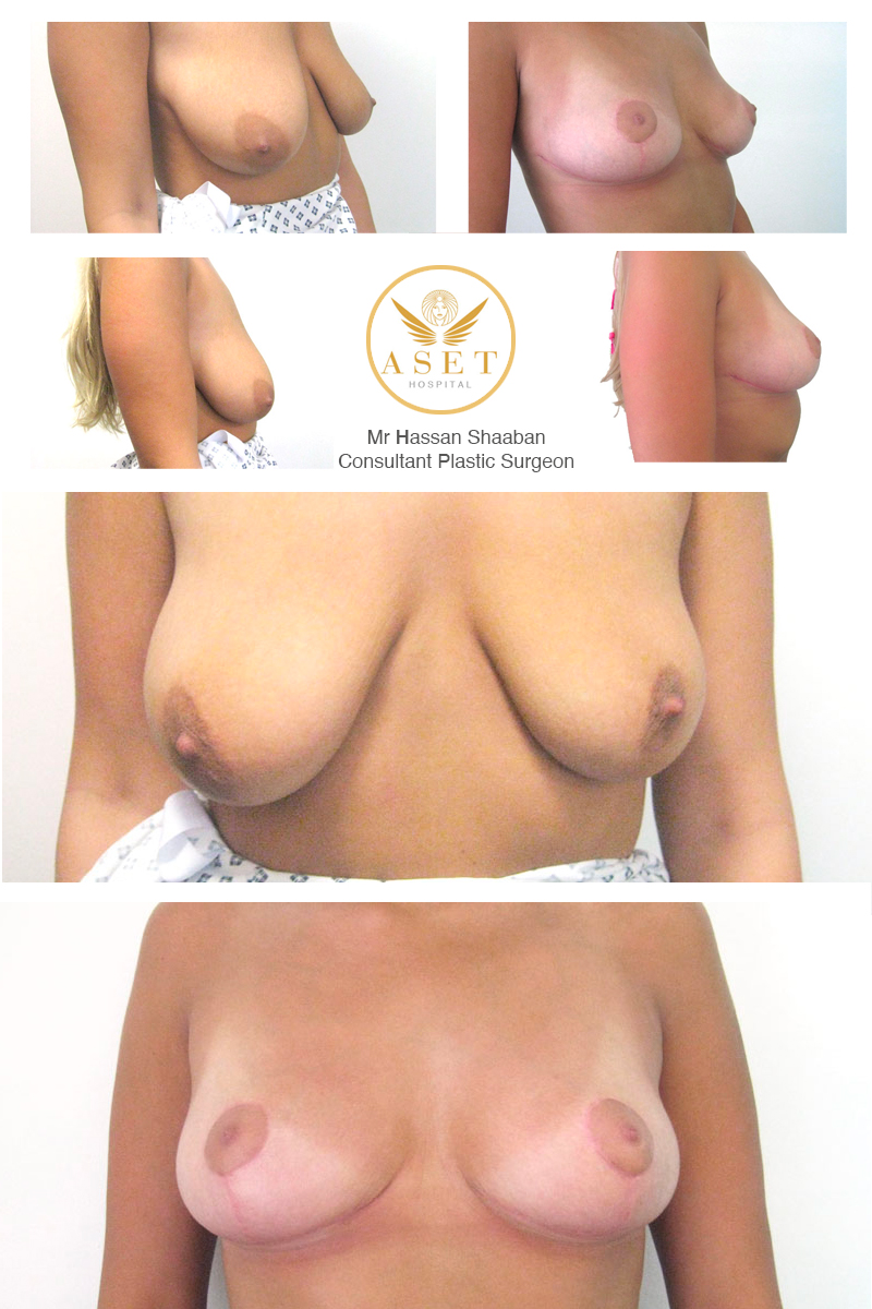 before and after photographs of breast asymmetry correction surgery performed by consultant plastic surgeon Mr Hassan Shaaban