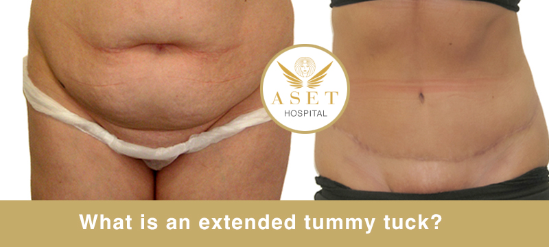 what is a extended tummy tuck