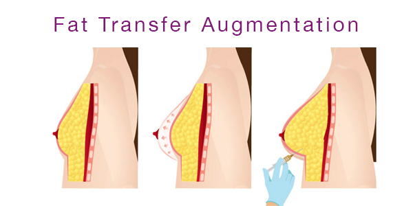 fat transfer natural breast enlargement