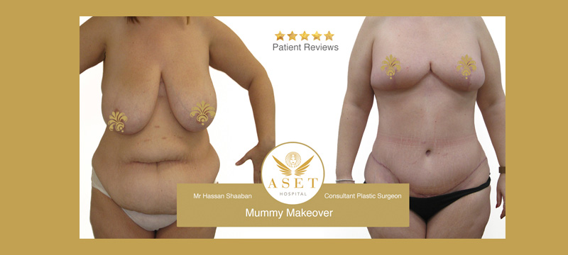 mummy makeover surgery at Aset Hospital Liverpool before and after photograph of a mummy makeover procedure