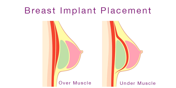 where does the breast implant go under or over the muscle